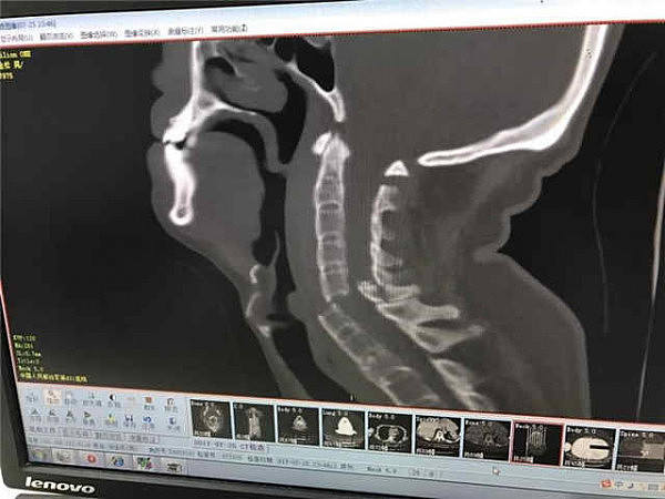 网约车司机颈椎被乘客打断 住院近两月伤重不治（图） - 1