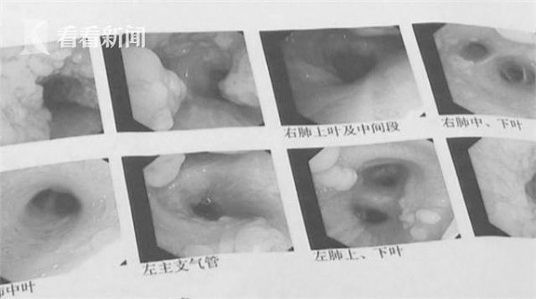 视频｜震惊！男子患上罕见病 气管内壁竟长满“小牙齿”