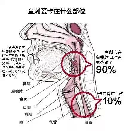 误吞鱼刺 28岁妈妈抢救7天人还是没了...（图） - 3