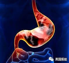 男孩腹痛不止15年，竟发现死去的双胞胎，一直睡在他的肚子里…（组图） - 7