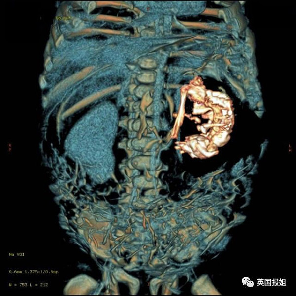 男孩腹痛不止15年，竟发现死去的双胞胎，一直睡在他的肚子里…（组图） - 17