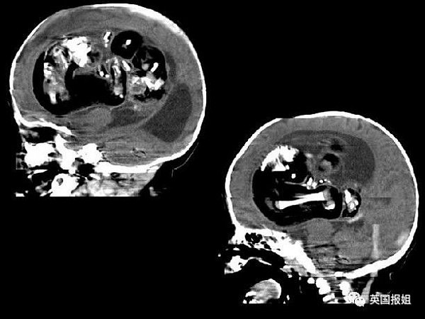 男孩腹痛不止15年，竟发现死去的双胞胎，一直睡在他的肚子里…（组图） - 18