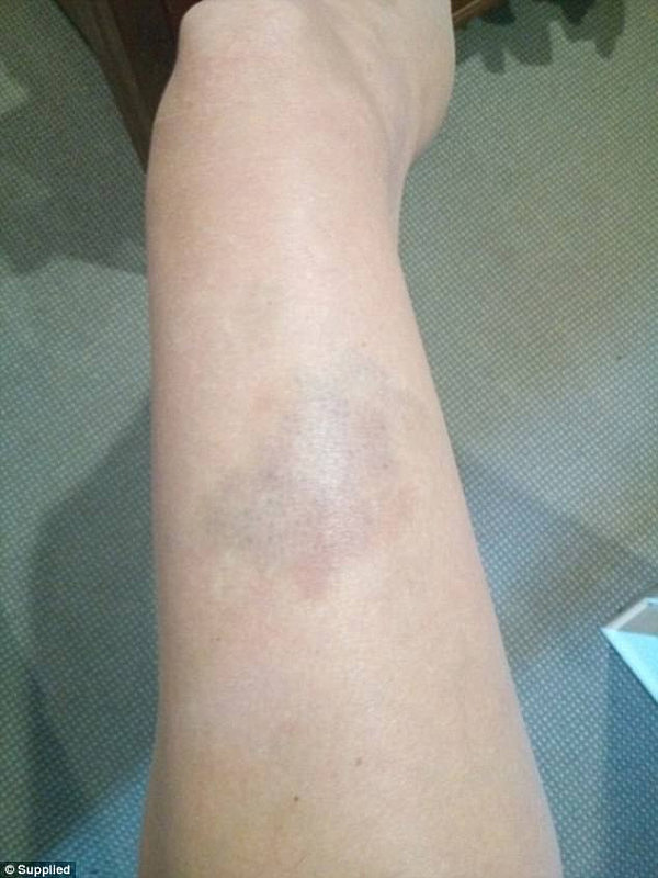 453551BF00000578-4968118-The_woman_shows_off_a_huge_bruise_where_her_attacker_pinned_her_-a-24_1507679661101.jpg,0