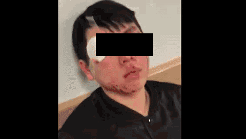 气愤！中国孩子在澳洲首都被“钉”在墙上打！眉骨开裂，满脸是血！一只眼睛短暂失明！目前警方与当地教育局已介入！华人需发声！ - 3