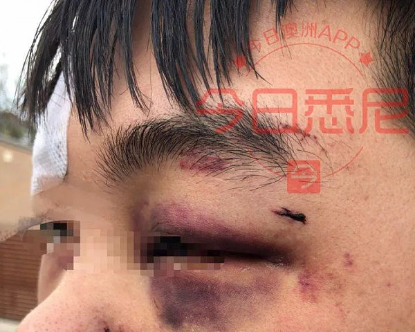 气愤！中国孩子在澳洲首都被“钉”在墙上打！眉骨开裂，满脸是血！一只眼睛短暂失明！目前警方与当地教育局已介入！华人需发声！ - 9