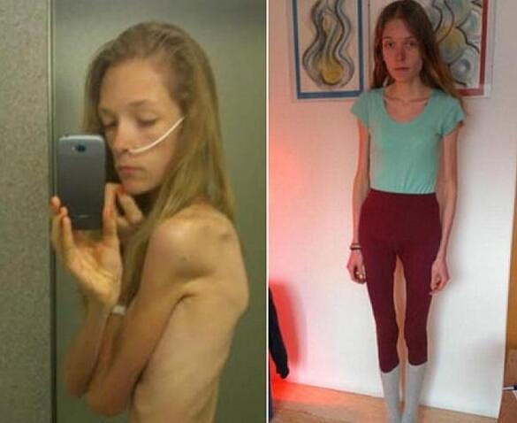 22岁女孩患厌食症，体重只有30公斤，像一个活生生的“骷髅人”