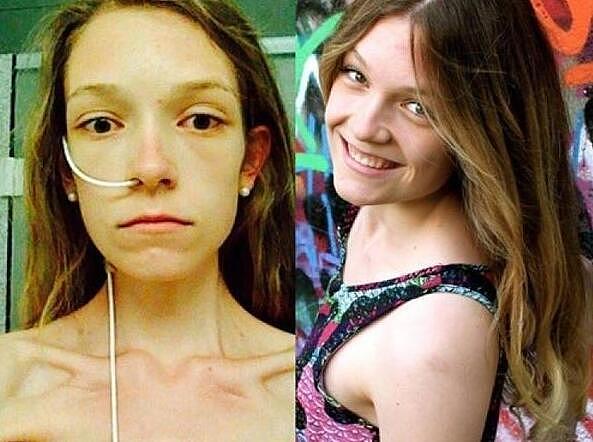 22岁女孩患厌食症，体重只有30公斤，像一个活生生的“骷髅人”