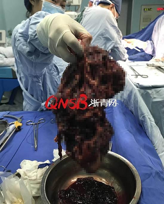杭州一妇女肚子大得像怀双胞胎，医生从里面取出一个脸盆大的肾！