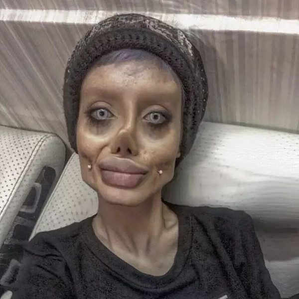 想变成安吉丽娜朱莉的样子，她做了50次整容手术，结果最后把自己变成了僵尸脸...
