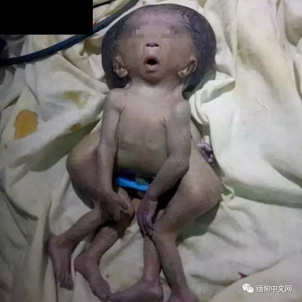 缅甸孕妇产检显示三胞胎，孩子出生那刻全家崩溃了！