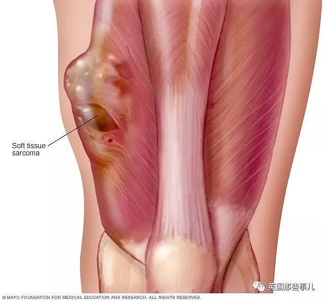 为了保住他的足球梦，医生把他右腿截下，调转180度，接了回去