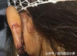她被叶璇的狗咬到毁容至今没收到补偿，整容后再次出演多部热播剧 - 9