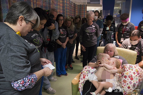 美国女子产下连体双胞胎，75名医生忙活了7小时成功分离 - 1