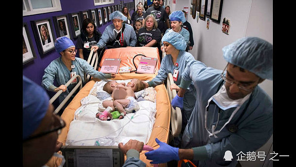 美国女子产下连体双胞胎，75名医生忙活了7小时成功分离 - 3
