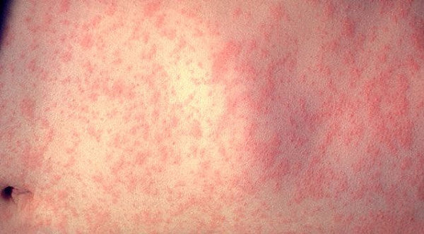 measles-vic-art2.jpg,0