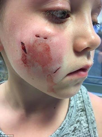 哈士奇抢7岁小女孩食物 一口在其脸上咬出4个血洞（图） - 1