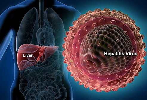 webmd_rf_photo_of_liver_and_hepatitis_virus.jpg,0
