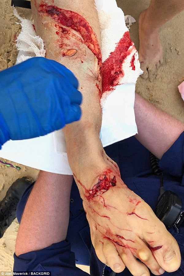 血腥慎点！悉尼女子遭大白鲨袭击 腿部被咬到血肉模糊 多地海滩紧急关闭（组图） - 3