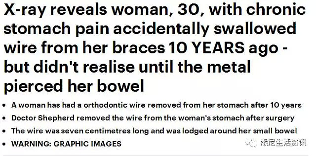 澳洲女子一天突然肚子剧痛，到医院检查后发现，罪魁祸首竟是这个她10年前放在嘴里的东西…… - 2