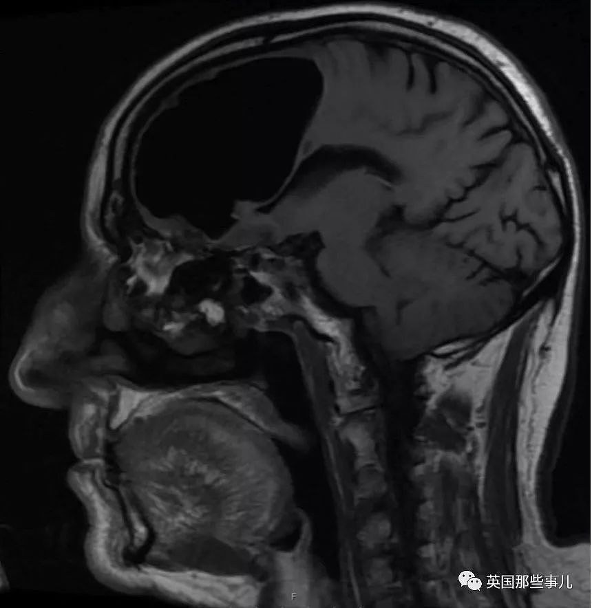 别人是脑子进水…这位大爷有点惨…脑子漏气... - 1