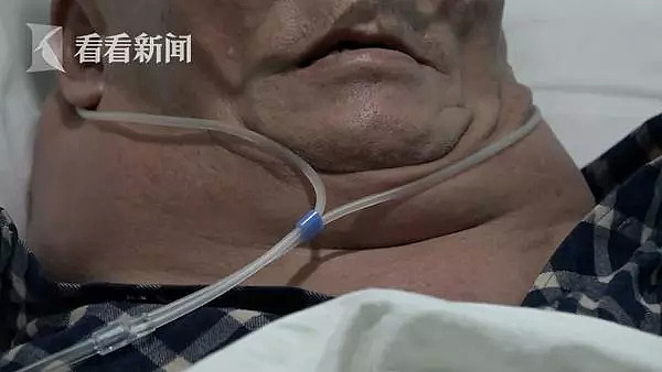 震惊澳媒！70％汉族人存在这种遗传缺陷！中国大爷脖子长出巨型肿块，只因为他40年来每天做这件事！ - 11