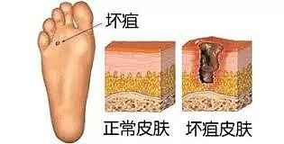 被自家狗舔了一口，让他毁了容、失去了双腿和6根手指....每年有44000人因此病而丧命！ - 10