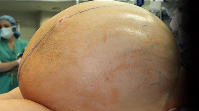 美国女子卵巢肿瘤重达60公斤 12位外科医师帮切除 - 1