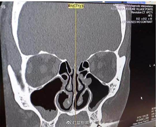 CT显示肯德拉鼻腔左侧漏液 图据CNN
