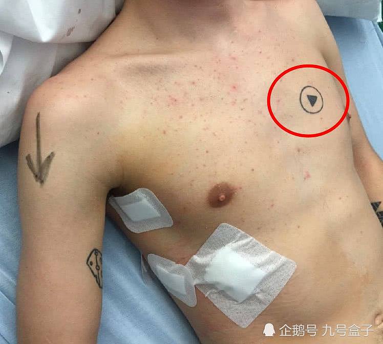 好险！男子在胸口纹了个箭头图案，差点让手术医生开错刀 - 1