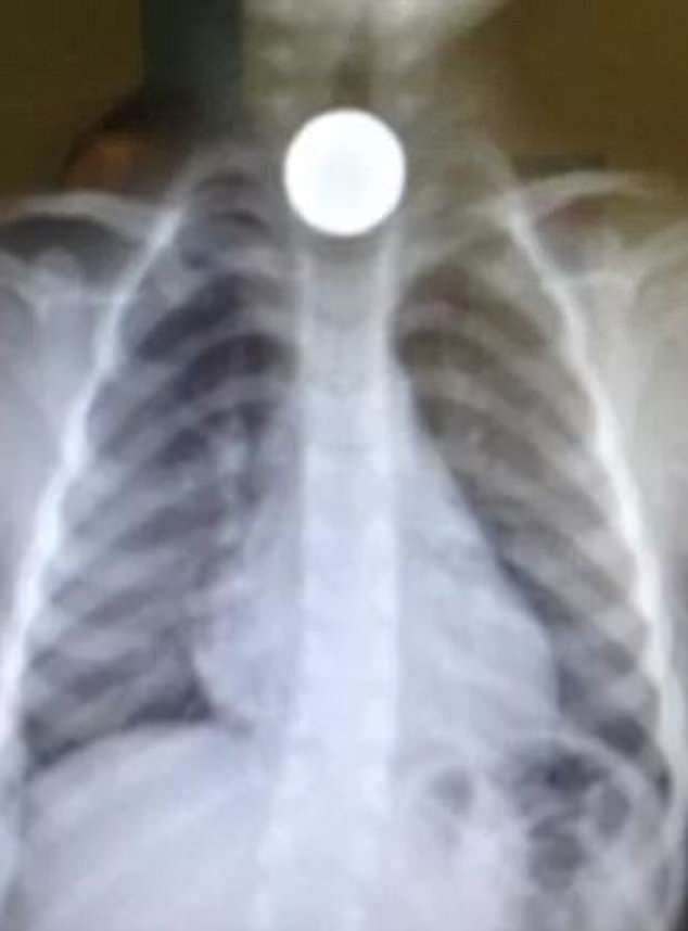 Three-year-old Bronte Read was rushed to hospital after swallowing a coin. An X-Ray of the coin trapped in her body is pictured