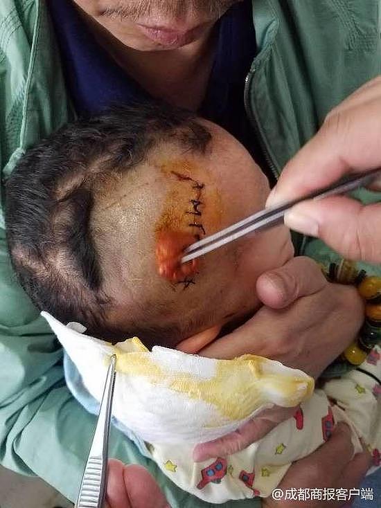 3岁男孩被狗扑倒咬伤头部缝10针 其父将狗打死在地