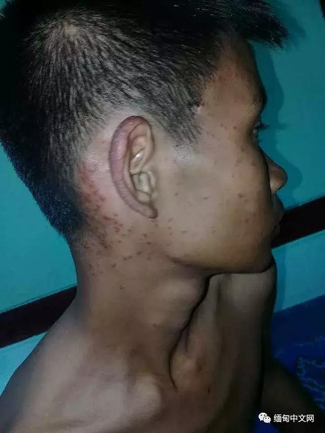 缅北16岁男孩踩地雷“被死亡”，丧事当天现身讲述7天痛苦经历！