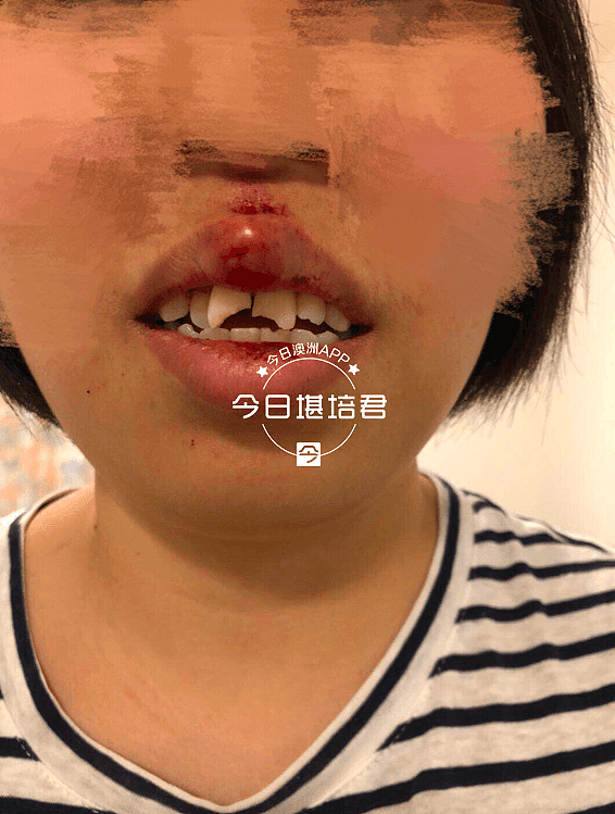 中国女留学生当街无故遇袭，牙齿磕断满口血！嫌犯疑精神异常，华人近期在澳频遭殴抢！（组图） - 1