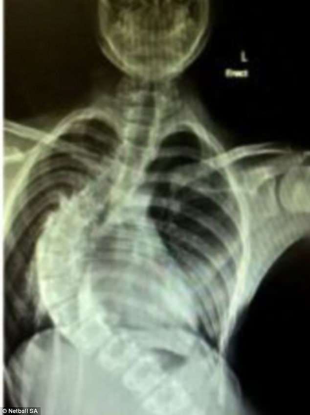 The talented netballer was bedridden with severe scoliosis. Pictured is an X-ray before surgery