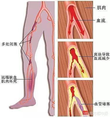 左下肢冰冷乏力疼痛 男子坐8小时飞机后险被截肢