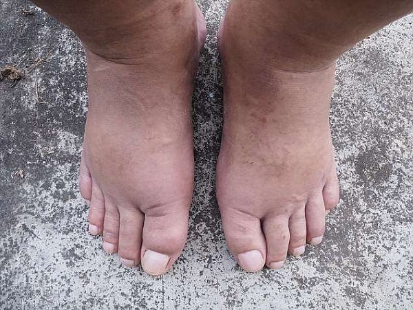 4DA449B100000578-5886267-Oedema_swelling_can_be_associated_with_other_conditions_includin-a-43_1530062571854.jpg,0