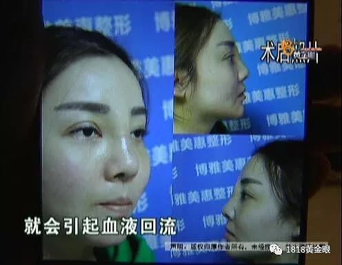 女子贷款三万做整形 结果肿成了“阿凡达”（组图） - 8