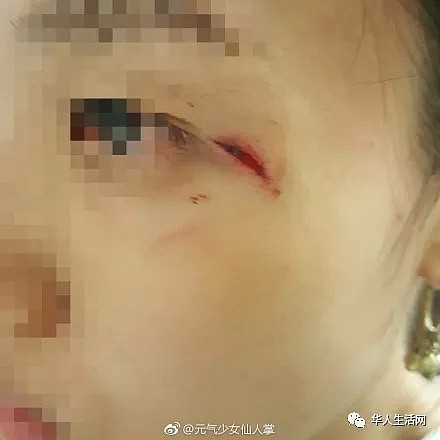 满脸是血，纽约街头华女遭受黑女群殴，警察却敷衍了事（组图） - 2