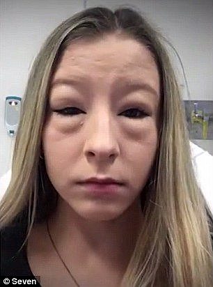 Jade Kwong (pictured) who has a nut allergy almost died after eating a burger. She suffered severe swelling around her eyes