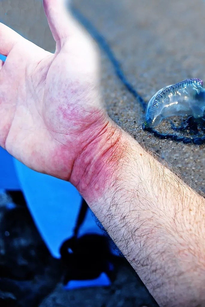 可怕！在澳大利亚的海边，看到这种塑料袋千万别捡！碰一下，可能命就没了...（组图） - 8