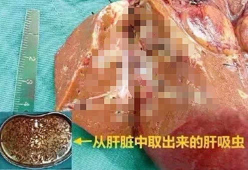 男子肝脏被上百条虫掏空 只因爱吃这种食物（组图） - 1