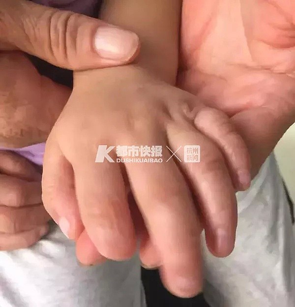3岁男孩啃掉自己手指，竟不哭不闹！这病无药可医…（组图） - 1