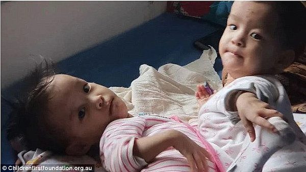 亚裔连体双胞胎女婴今日抵澳，将耗资$30万做分离手术！9年前曾有成功案例（组图） - 1