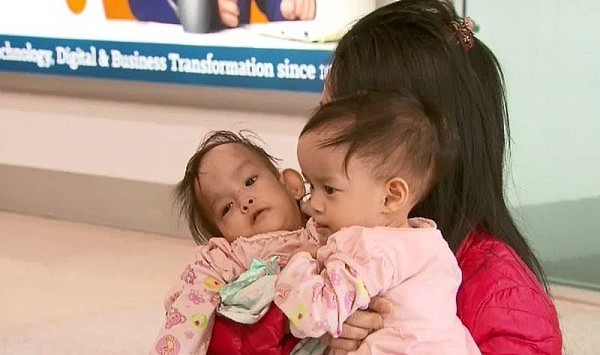 亚裔连体双胞胎女婴今日抵澳，将耗资$30万做分离手术！9年前曾有成功案例（组图） - 3