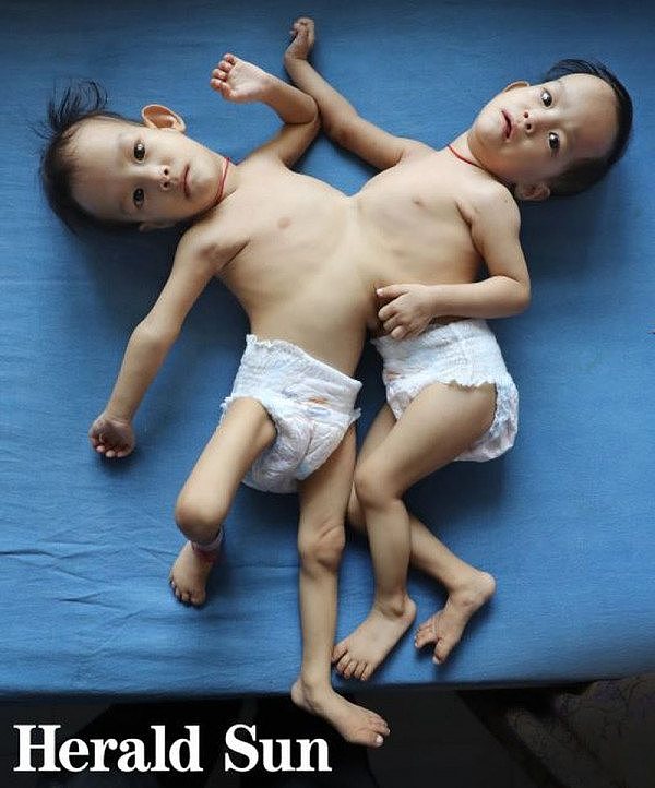 亚裔连体双胞胎女婴今日抵澳，将耗资$30万做分离手术！9年前曾有成功案例（组图） - 4