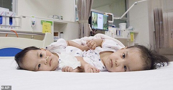给澳洲医生点赞！亚洲连体女婴成功接受分离手术（组图/视频） - 2