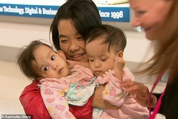 给澳洲医生点赞！亚洲连体女婴成功接受分离手术（组图/视频） - 5