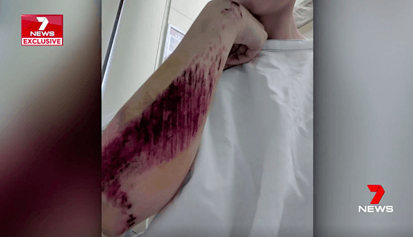 可怕！澳女网售腰带遇诈 被汽车拖着跑了250米 身体多处严重划伤（组图） - 4