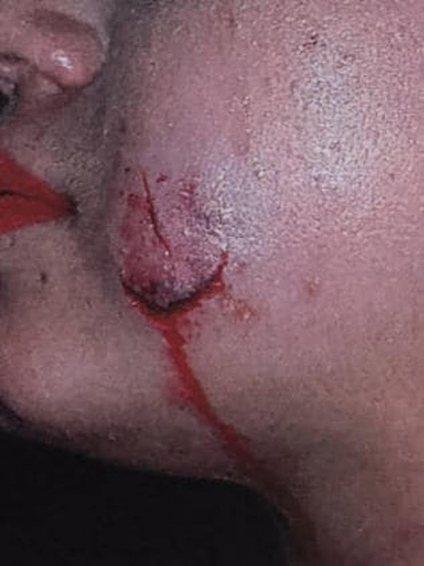 泰森咬耳朵她咬脸！悉尼酒吧美女互殴脸上咬出一个血洞（图） - 1