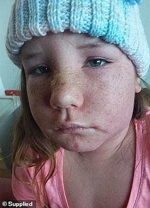 恐怖！澳洲常见药，致8岁女童产生严重过敏反应，器官双肺均衰竭！（组图） - 2